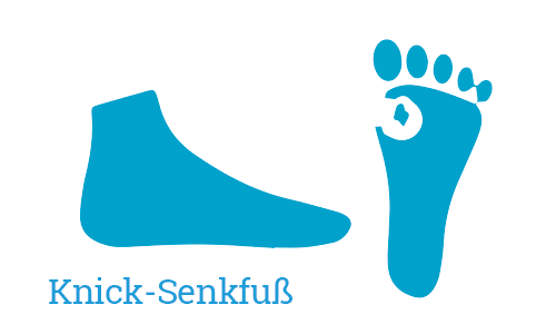 Knick-Senkfuß